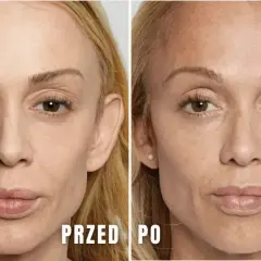 Przed i po zabiegu z użyciem kwasu polimlekowego stymulatora. Skóra twarzy jest gładsza, bardziej napięta i odmłodzona.