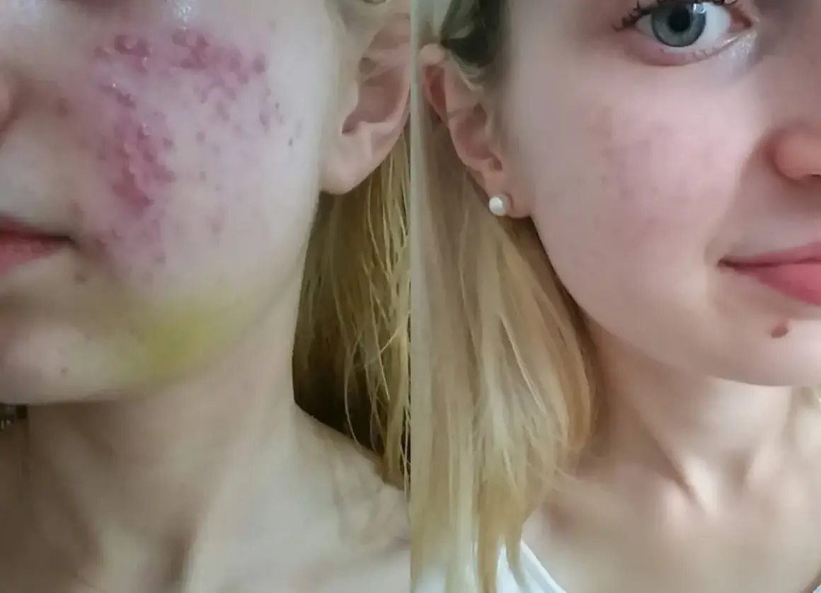 Przed i po leczeniu izotekiem: skóra z trądzikiem i bliznami po kuracji.