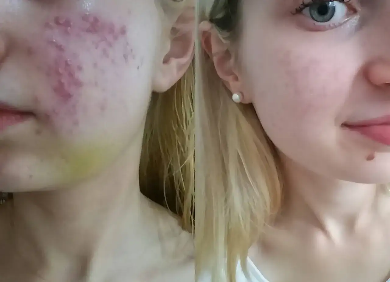 Izotek na trądzik - dla kogo, kuracja i pielęgnacja