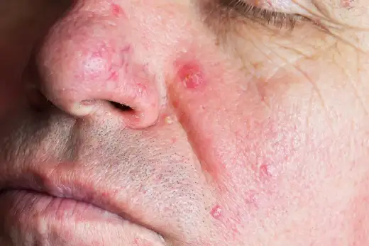 Bruzda na nosie - Kiedy to alergia, a kiedy problem skórny?
