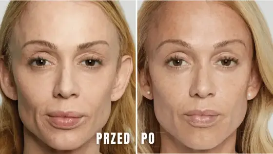 Kwas polimlekowy - Efekty, cena, działanie. Czy to dla Ciebie?